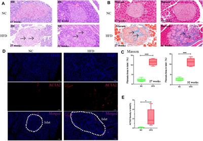 Glucotoxicity Activation of IL6 and IL11 and Subsequent Induction of Fibrosis May Be Involved in the Pathogenesis of Islet Dysfunction